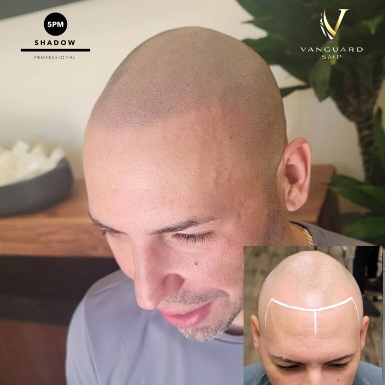 Hair Loss Solution - Scalp Micropigmentation Process