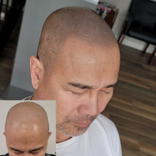 Hair Loss Cured by Micropigmentation