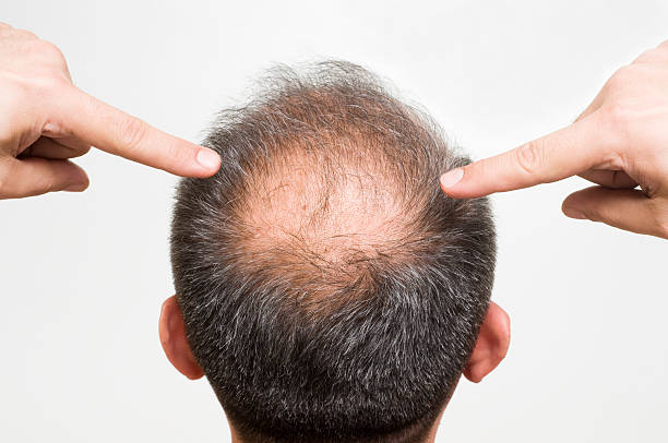 Scalp Micropimentation - How It Works